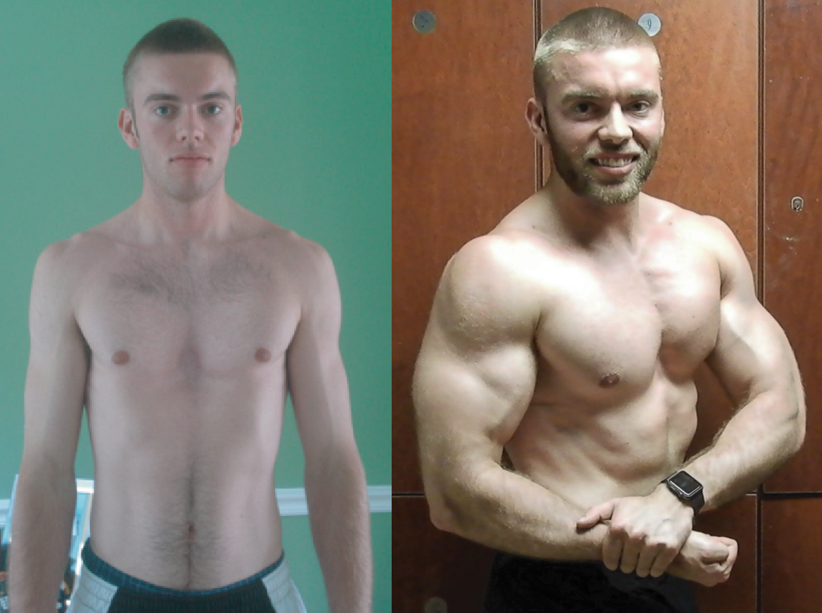 My pectus excavatum before and after progress